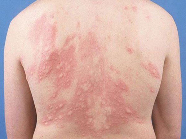 Những bệnh về da vào mùa lạnh dễ tái phát