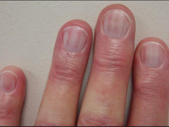 Những dấu hiệu bệnh thể hiện trên móng tay