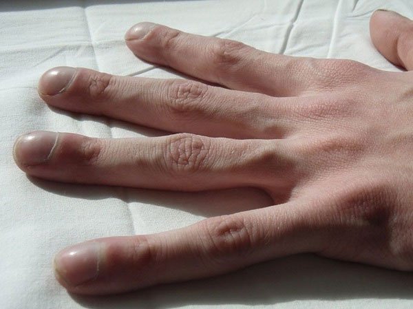 Những dấu hiệu bệnh thể hiện trên móng tay