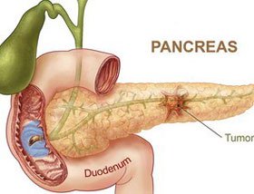 Phát hiện sớm ung thư tuyến tụy và ung thư mật