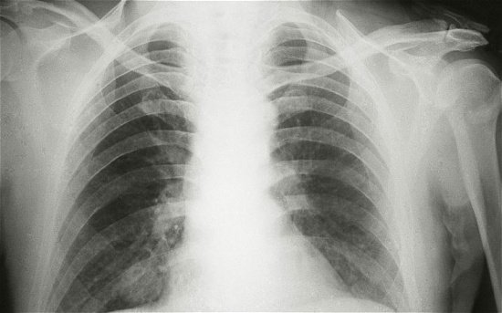 Phát hiện thêm về virus EMC mới gây viêm phổi