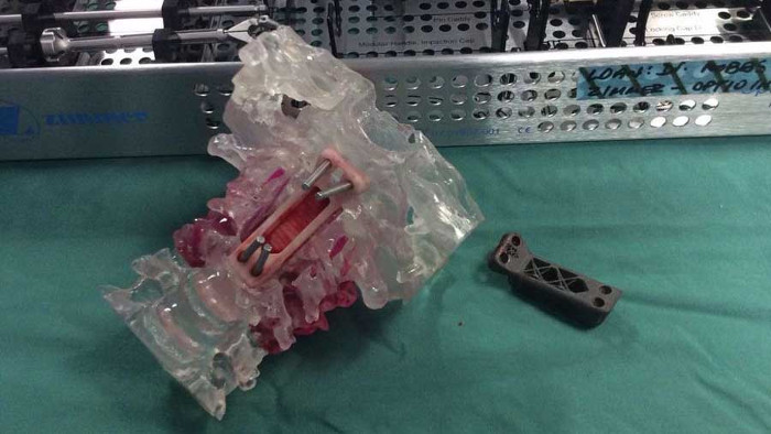 Phẫu thuật cấy ghép đốt sống cổ bằng công nghệ in 3D đầu tiên đã thành công
