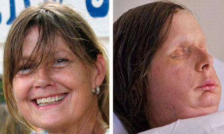Phẫu thuật thành công khuôn mặt bị biến dạng hoàn toàn