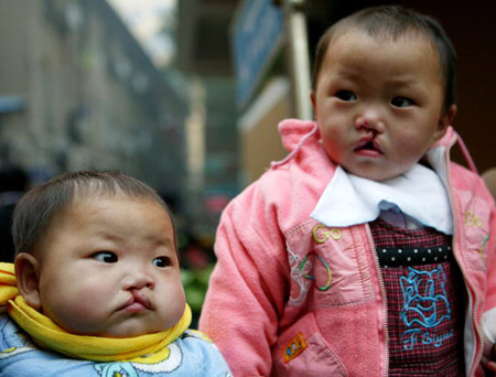 Số trẻ khuyết tật Trung Quốc tăng vì ô nhiễm