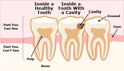 Tại sao hàn răng sâu không hề đau và đáng sợ như bạn nghĩ?