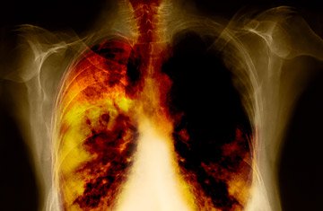 Tầm soát bệnh ung thư phổi ở giai đoạn đầu