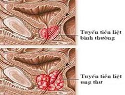 Thuốc mới điều trị ung thư tiền liệt tuyến