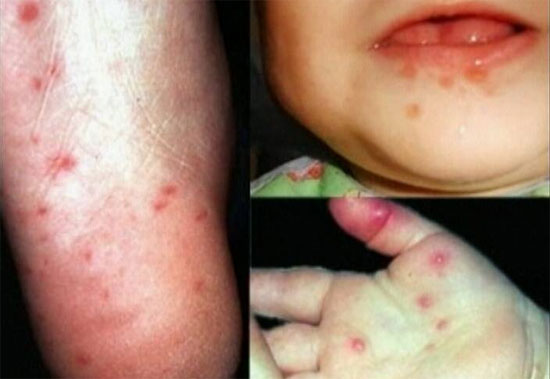 Trung Quốc tuyên bố chế được vắc-xin bệnh tay-chân-miệng