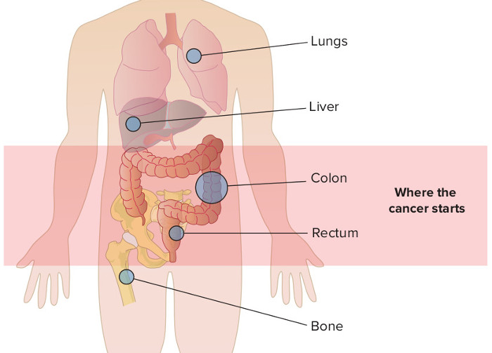 Ung thư di căn là gì?