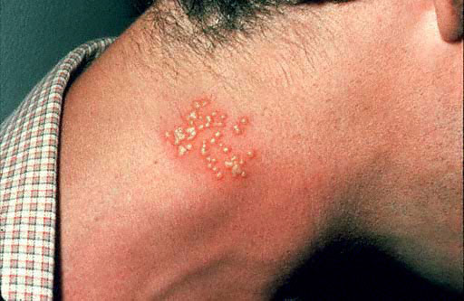 WHO cảnh báo: 50% dân số thế giới có thể mắc bệnh Herpes
