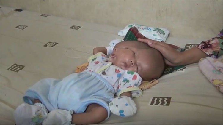 Bé trai Indonesia mắc dị tật hiếm gặp nhất: sinh ra với 2 khuôn mặt và 2 bộ não