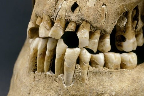 Dù không ăn đường, uống nước có ga nhưng người cổ đại vẫn bị sâu răng?