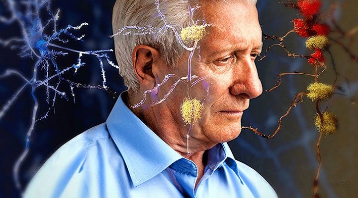 Thuốc chữa Alzheimer mới đạt kết quả điều trị khả quan