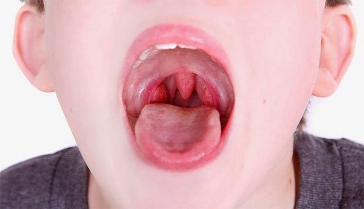 10 nguyên nhân khiến cổ họng có cảm giác bị vướng