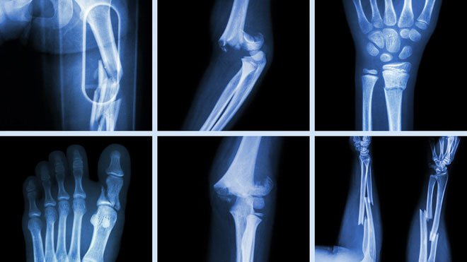 5 điều mọi người hay hiểu lầm về xương