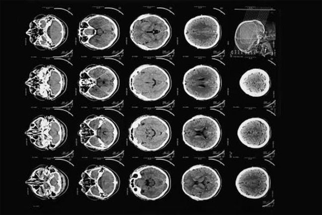 50 năm chiếc máy chụp CT đầu tiên cho bác sĩ nhìn thấu bên trong hộp sọ