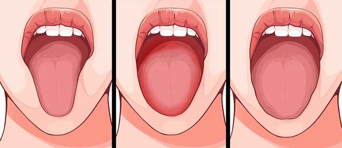 6 sự thay đổi của lưỡi có thể tiết lộ rất nhiều về sức khoẻ