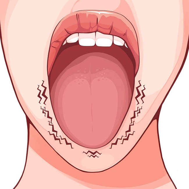6 sự thay đổi của lưỡi có thể tiết lộ rất nhiều về sức khoẻ