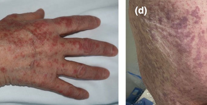 Bác sĩ chỉ 5 dấu hiệu điển hình trên da của người mắc Covid-19
