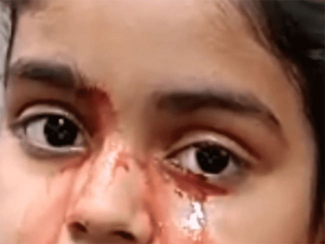 Bé gái 11 tuổi khóc ra máu ở Ấn Độ