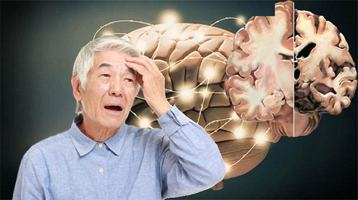 Bệnh Alzheimer là gì?