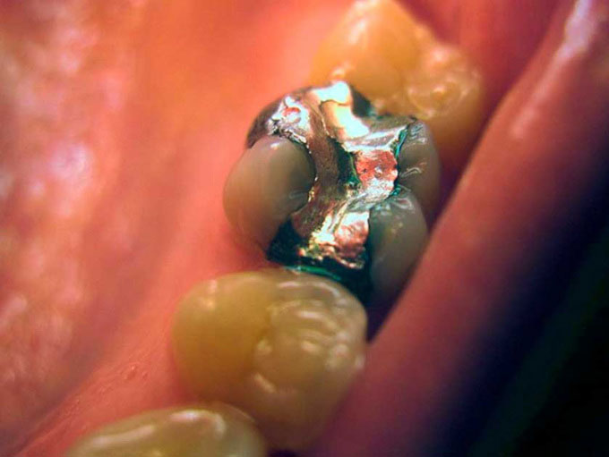 Bệnh dịch răng nổ kỳ lạ vào thế kỷ 19