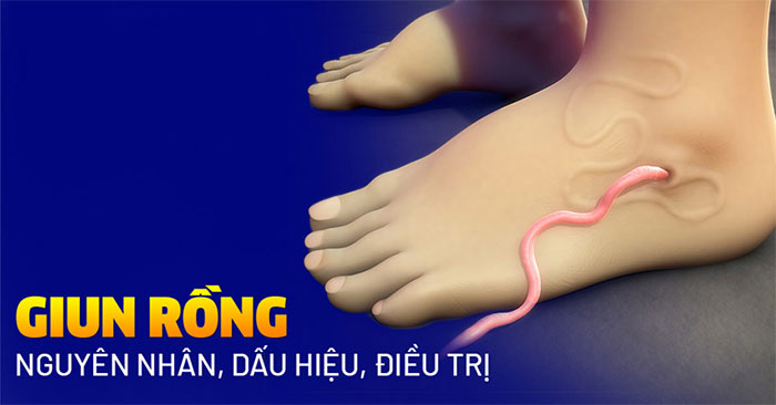 Bệnh giun rồng: Nguyên nhân, triệu chứng và cách điều trị