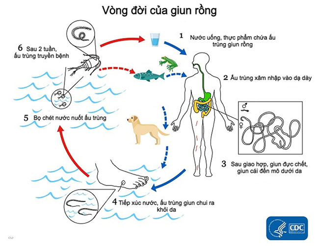 Bệnh giun rồng: Nguyên nhân, triệu chứng và cách điều trị