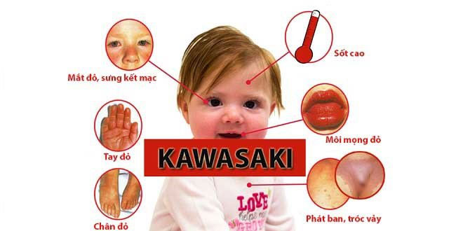 Bệnh Kawasaki: Nguyên nhân, triệu chứng và cách điều trị