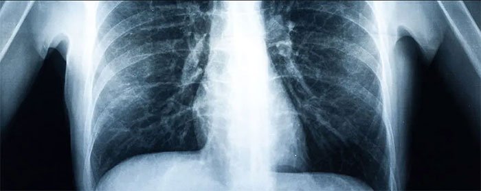 Bệnh nhân đầu tiên trên thế giới phải ghép phổi do hút vape