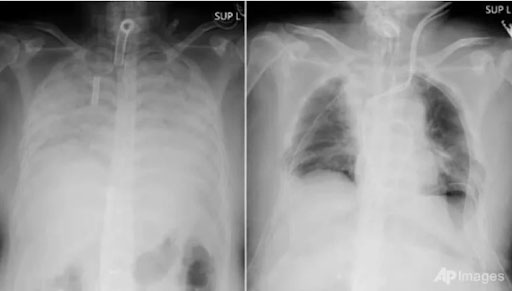 Bệnh phổi trắng: Nguyên nhân, triệu chứng và cách điều trị