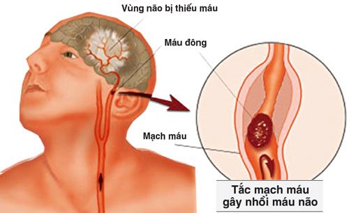 Bệnh rối loạn tuần hoàn não: Nguyên nhân, triệu chứng và cách điều trị