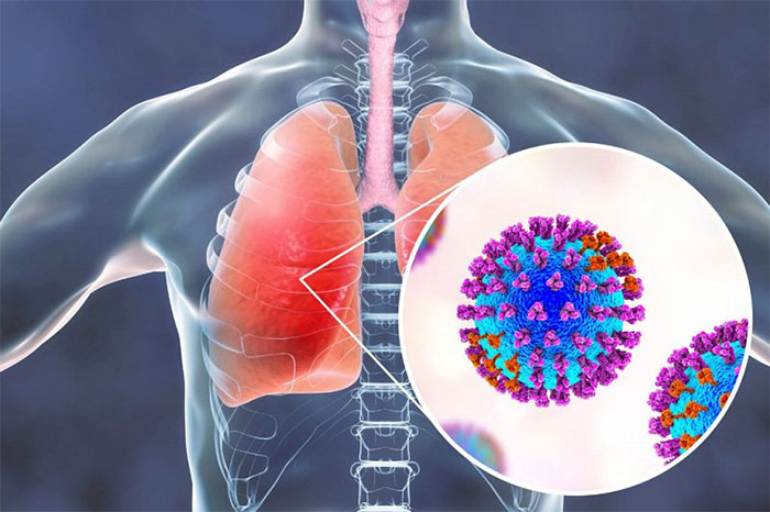 Bệnh viêm phổi là gì?