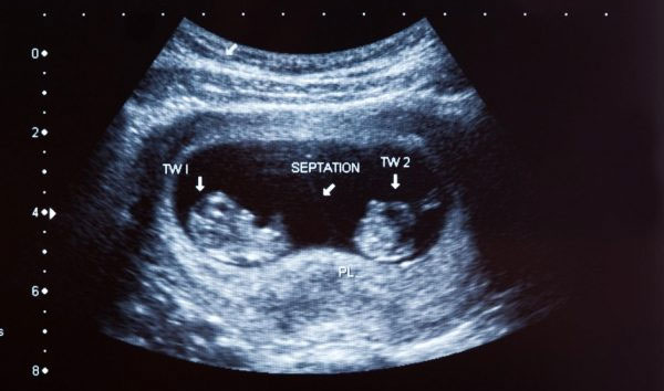 Bệnh viện Phụ sản Hà Nội: Công bố ca song thai cùng trứng cực kỳ đặc biệt, thế giới mới ghi nhận 1 trường hợp