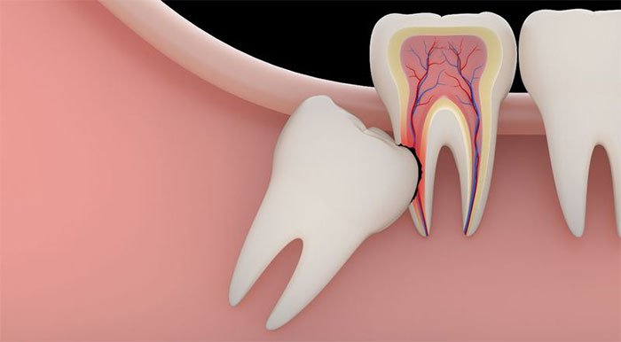Biến chứng nguy hiểm khi răng khôn mọc ngầm