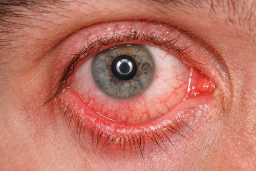Các loại dị ứng mắt và triệu chứng để phân biệt chính xác nhất
