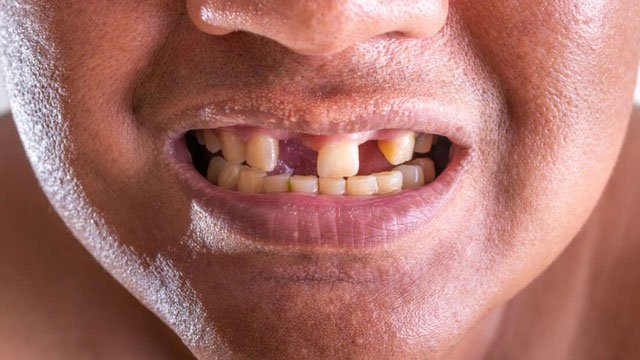Các nhà khoa học tìm ra cách có thể giúp con người mọc lại răng