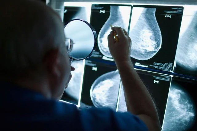 Các nhà nghiên cứu đã tìm ra cơ hội chặn ung thư vú