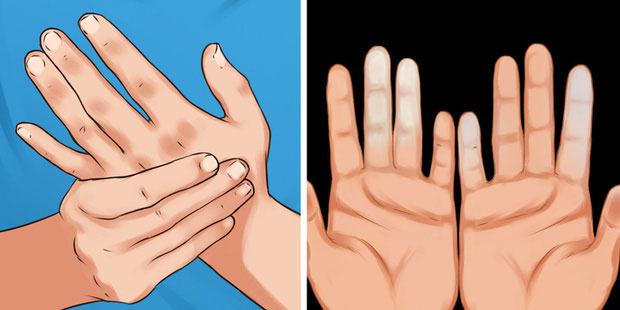 Cẩn thận với căn bệnh khiến ngón tay ngón chân bạn đổi màu trắng xanh khi gặp trời lạnh