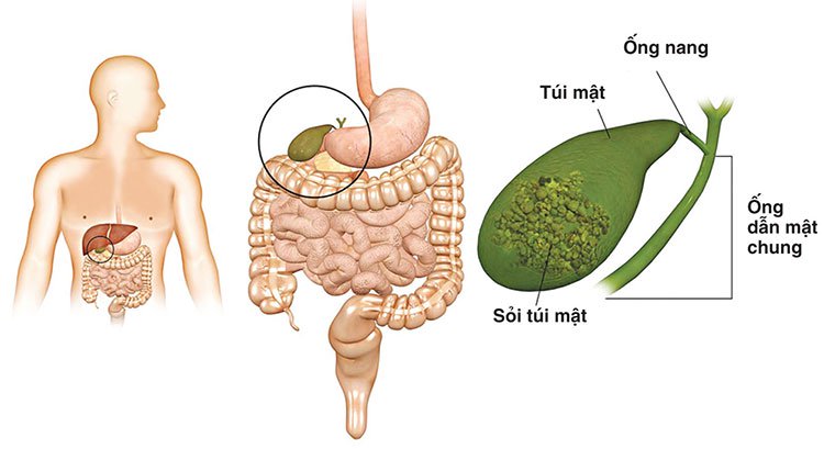 Cảnh báo ung thư đường mật di căn qua gan