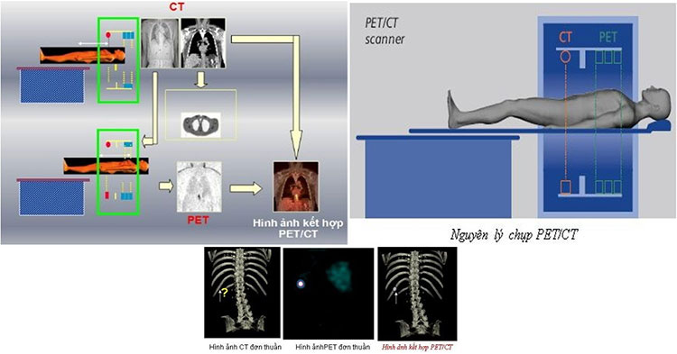 Chụp PET/CT là gì?