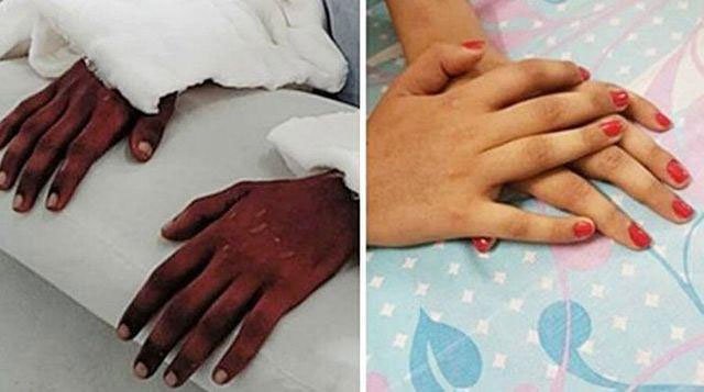 Cô gái được ghép tay từ nam thanh niên da đen, 2 năm sau điều kỳ diệu bỗng xảy ra