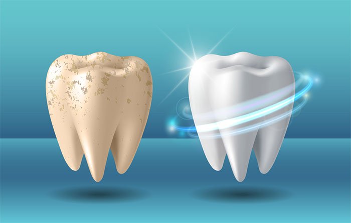 Điều gì sẽ xảy ra khi chúng ta tẩy trắng răng?