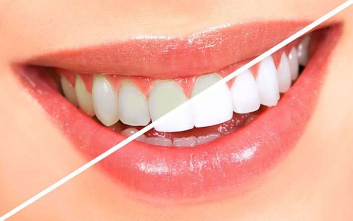 Điều gì sẽ xảy ra khi chúng ta tẩy trắng răng?