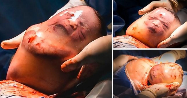 Em bé bĩu môi khi sinh ra trong bọc ối còn nguyên vẹn
