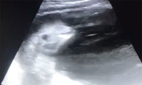Hình ảnh siêu âm của cá voi trắng trong bụng mẹ