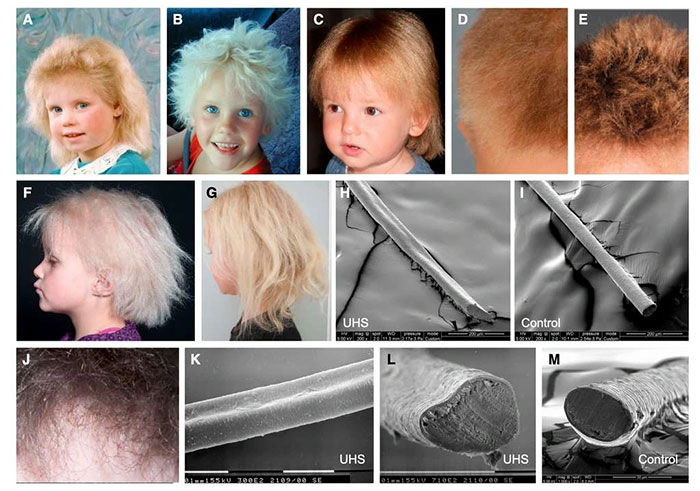 Kỳ lạ hội chứng tóc không thể kết hợp, tự biến mất khi trưởng thành