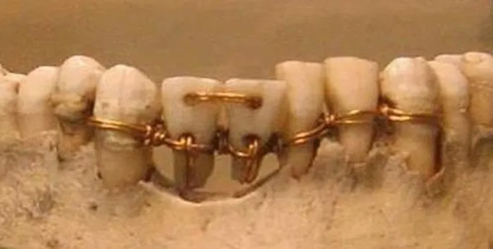 Lịch sử ra đời và phát triển của những chiếc răng giả