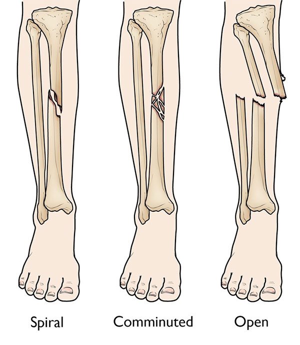 Mất bao lâu để hồi phục khi gãy xương cẳng chân?