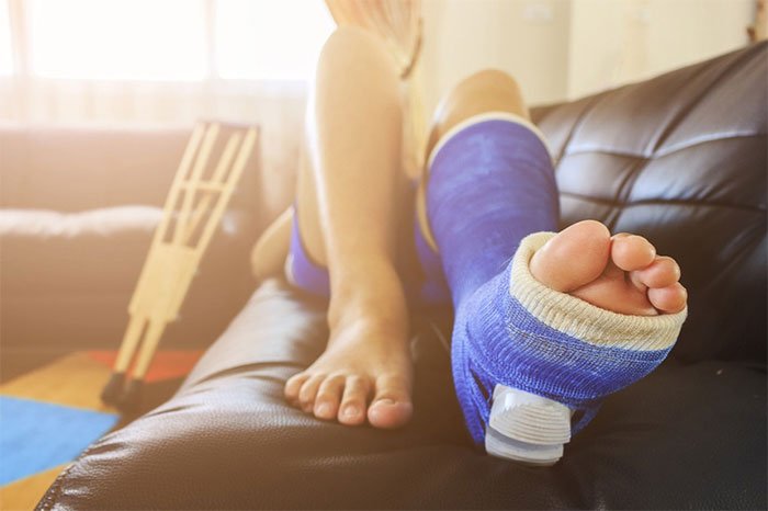 Mất bao lâu để hồi phục khi gãy xương cẳng chân?